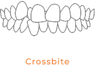 Crossbite