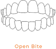 Open Bite