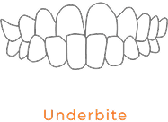 Underbite